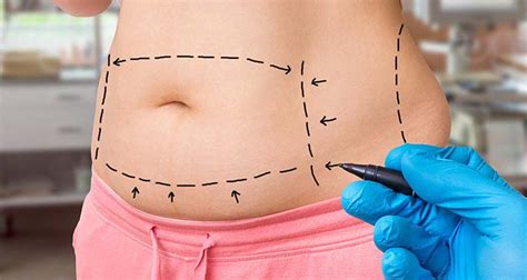 tummy tuck cost in tijuana|Tummy Tuck in Tijuana, Mexico: Cost and Guide